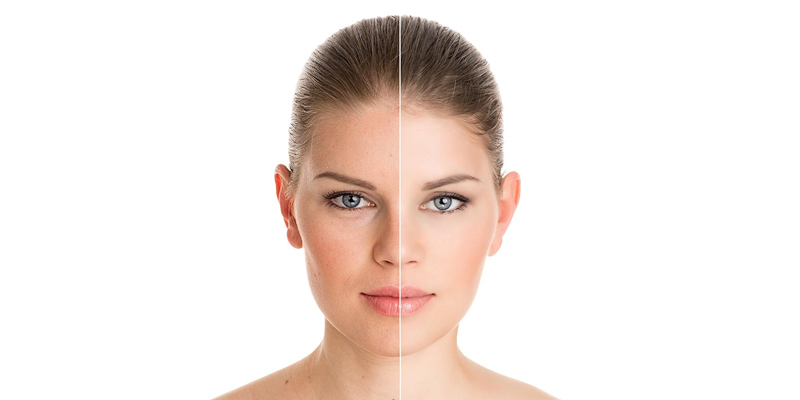 Can Face Pigmentation Be Removed by Laser?